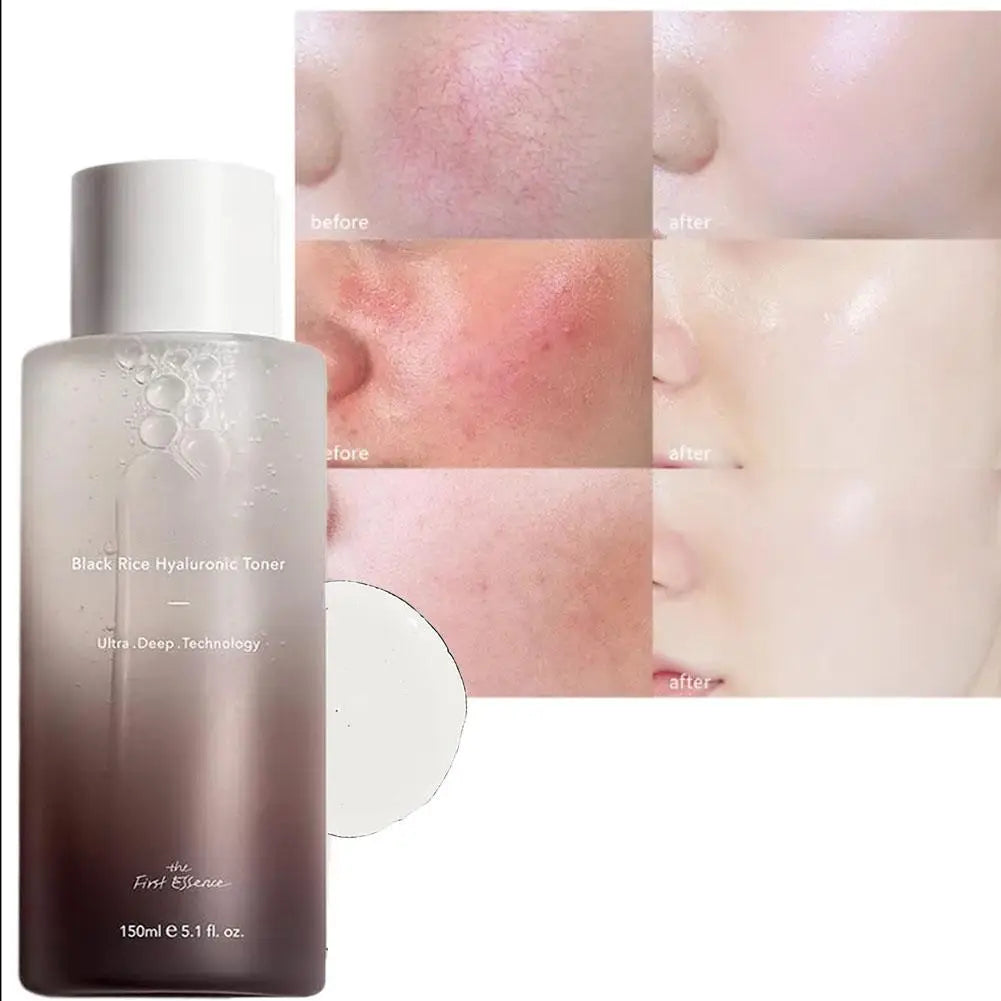 Haruharu Wonder Black Rice Toner Remove Acne Face Serum Moisturize Skin Rejuvenating Hyaluronic Acid Shrink Pore Face Skin Care